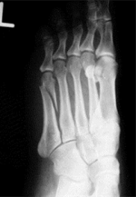 An x-ray of the foot